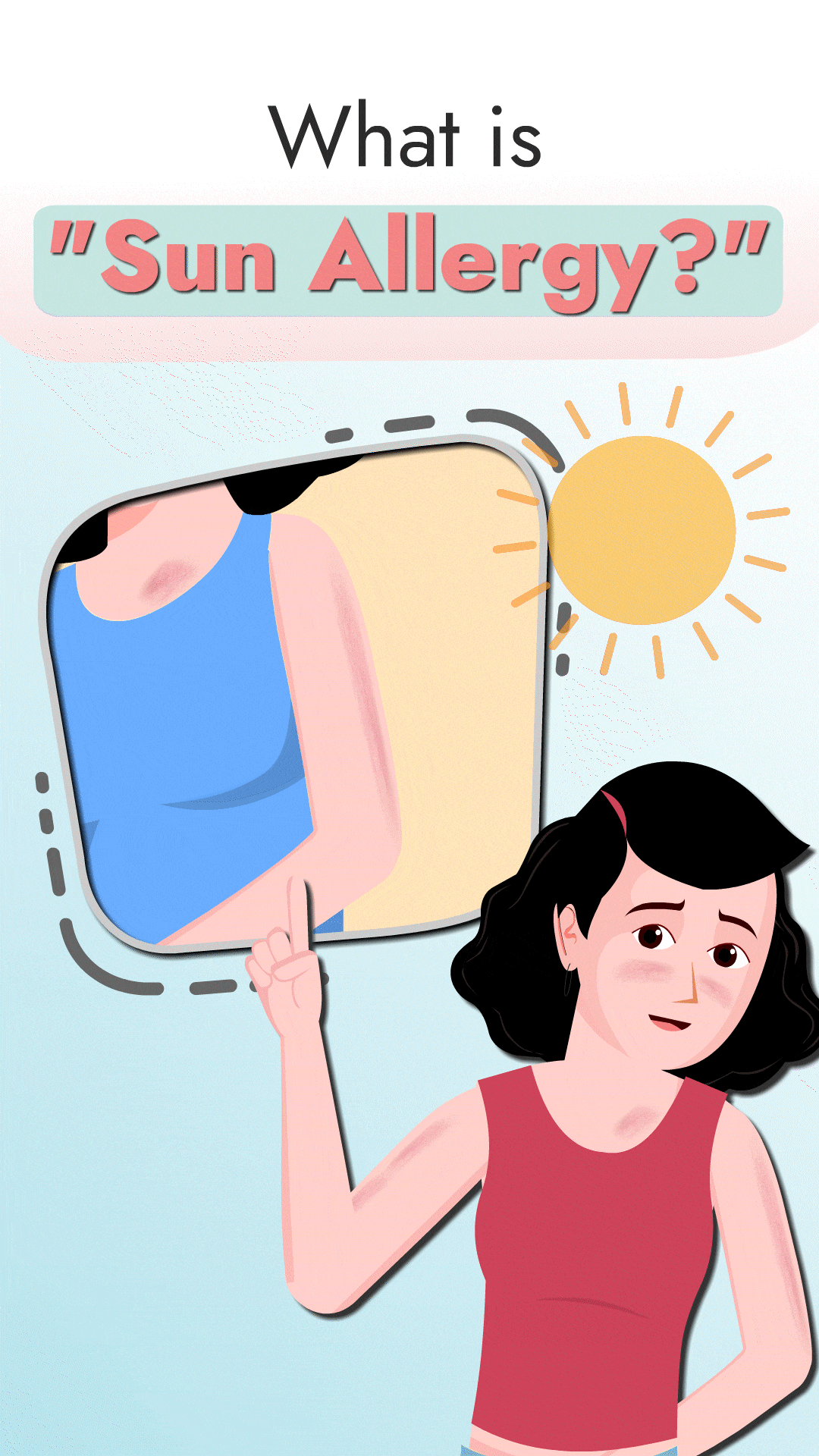 Sun Allergy Rash: Polymorphic Light Eruption