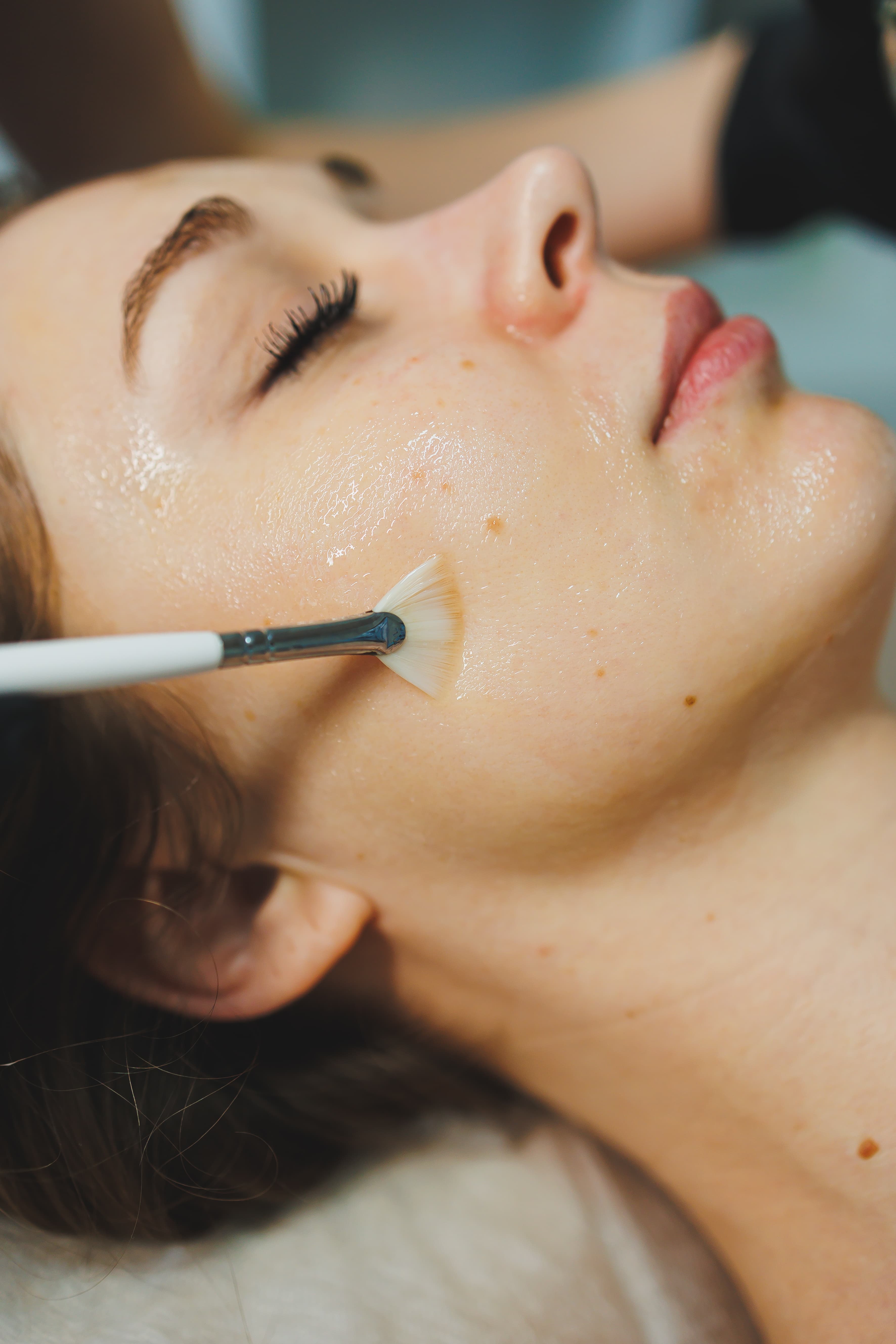Retinol Peel for Melasma