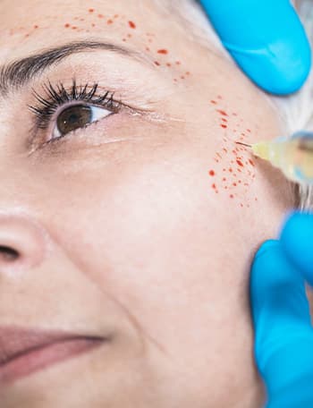 Vampire Facial - PRP Treatment for Face